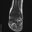 Snowboard fracture Talus