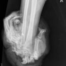 Amputation Hand