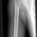 aneurysmatische Knochenzyste