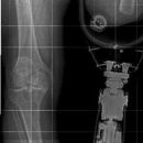 Ganzbeinaufnahme mit Beinprothese