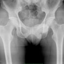 Cam FAI mit herniation pit