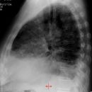Lungenfibrose DD atypische Infiltrate