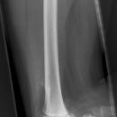Osteochondrom