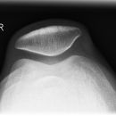 Patella1.jpg