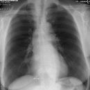 Pneumopericard