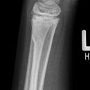 Wulstfraktur distler Radius